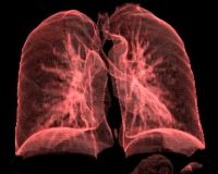 Akciğer Amfizemi