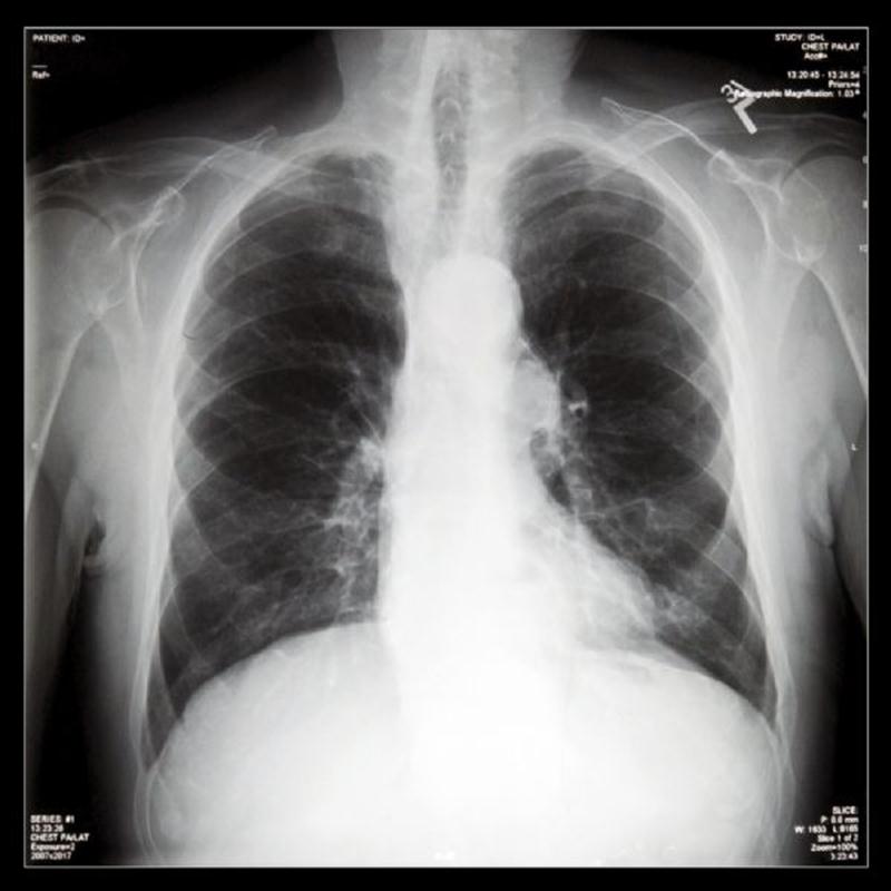 Akciğer Embolisi