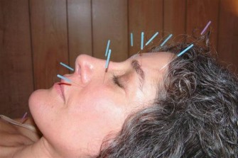 Akupunktur Faydaları
