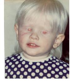 Albino hastalığı neden olur?