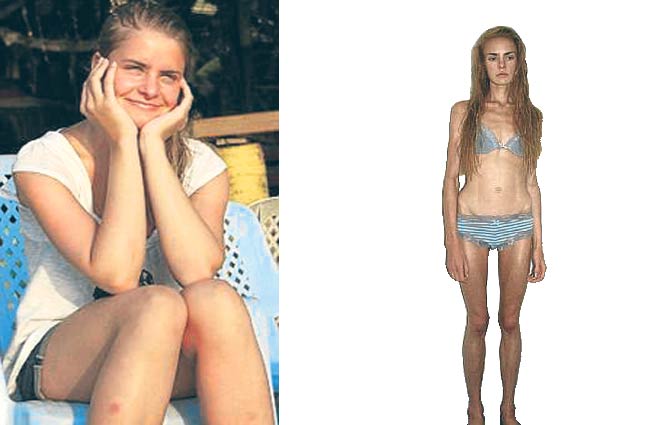 Anoreksik Kızın Ölümü Dizi Oldu