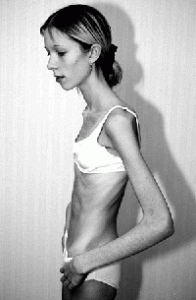Anoreksiya nervoza belirtileri nelerdir?
