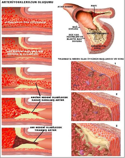 Arteriyosklerozun Erken Belirtileri Nedir Faydaları
