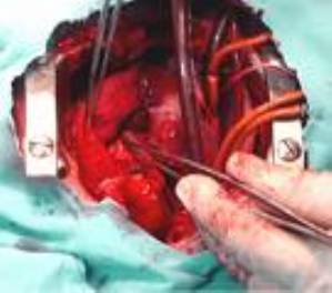 Bypass açık kalp ameliyatı nasıl yapılıyor?