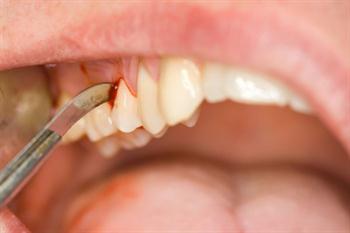 Diş apsesi nasıl geçer?