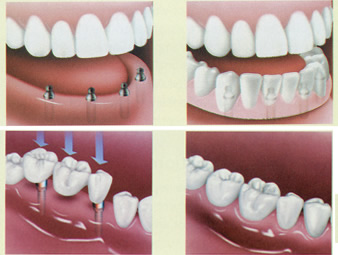 Diş implant fiyatları 2013