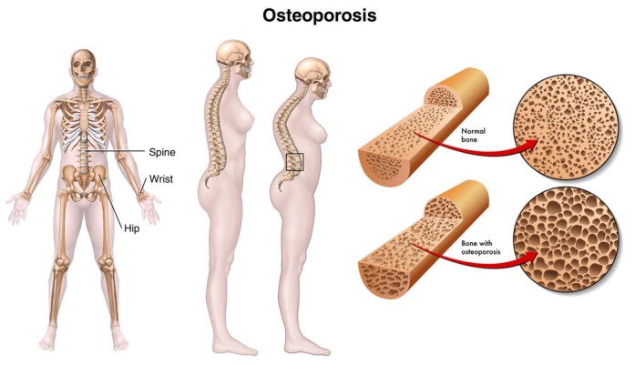 Osteoporoz (osteoporosis)
