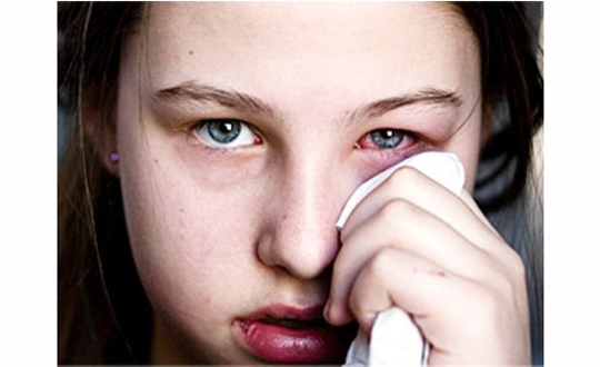 Polenler ve ev tozları göz alerjisi nedeni