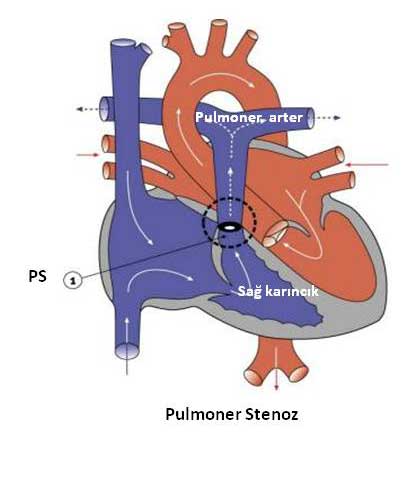 Pulmoner Stenoz