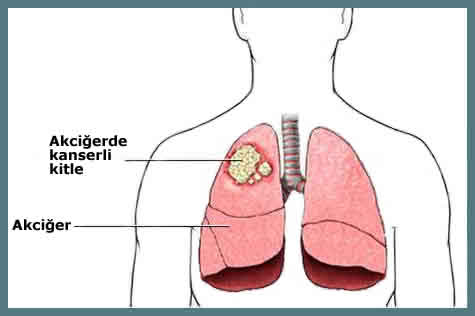Akciğer biyopsisi neden yapılır?