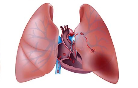 Akciğer Embolisi Faydaları