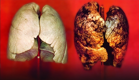 Akciğer Kanseri Faydaları