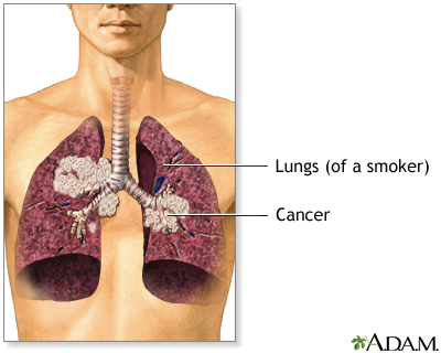 Akciğer kanserinde gelişme