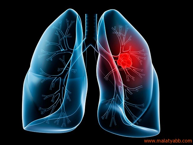 Akciğer kanserine bitkisel tedavi