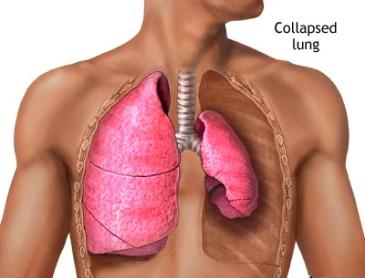 Akciğer sönmesi tedavisi