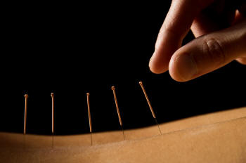 Akupunktur bel ağrısına faydalı