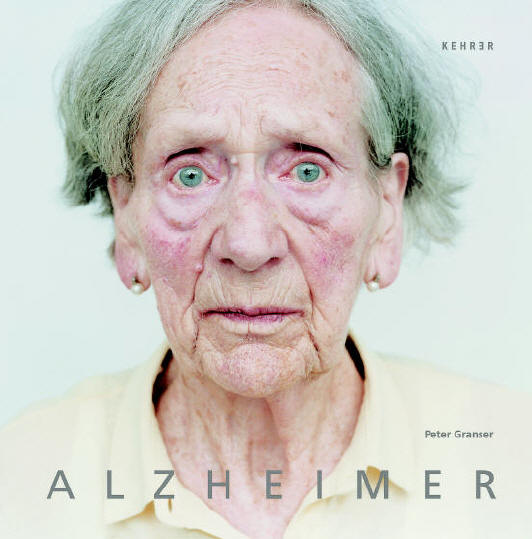 Alzheimer hastalığı belirtileri