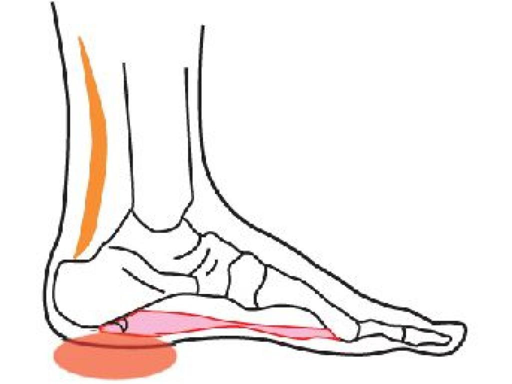 Ayak taban ağrıları neden olur?