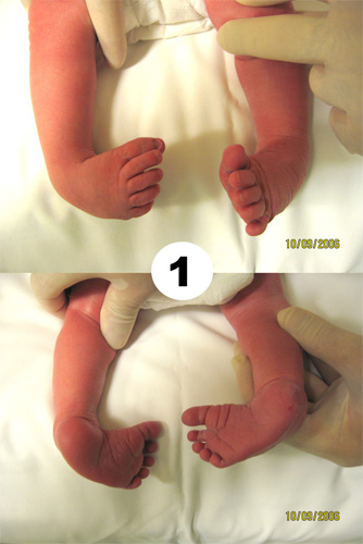 Bebeklerde çarpık ayak hastalığı!