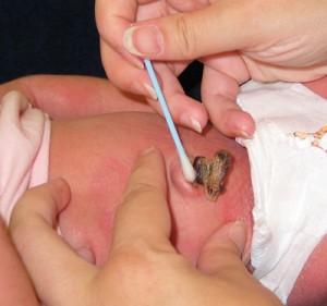 Bebeklerde göbek bağı bakımı