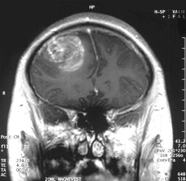 Beyin tümörü nasıl tedavi edilir?