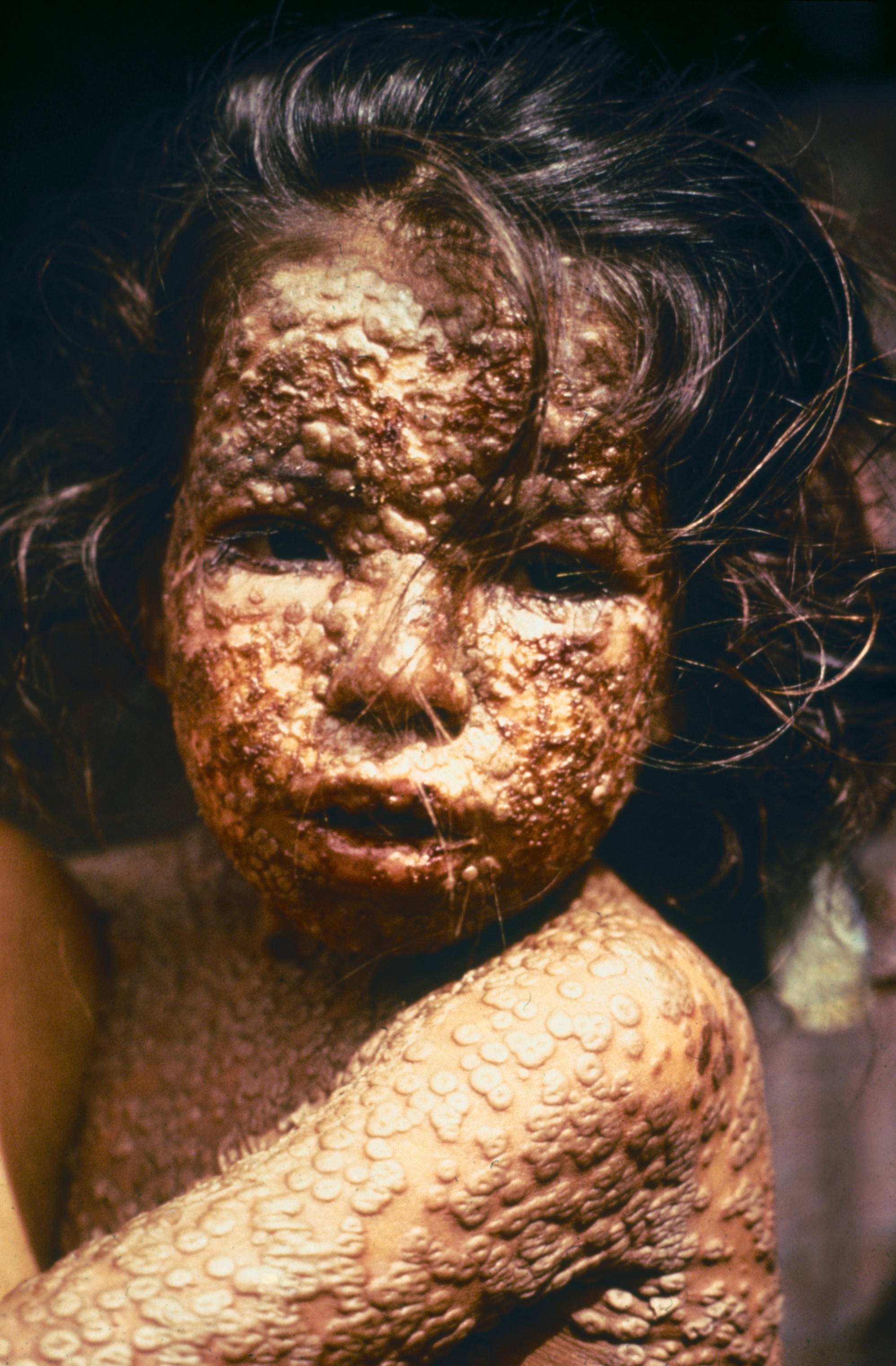 Çiçek Hastalığı (smallpox)