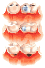 Çürük diş nasıl tedavi edilir?