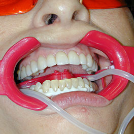 Diş beyazlatma yöntemleri