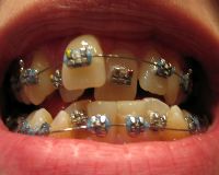 Diş çarpıklığı nedenleri