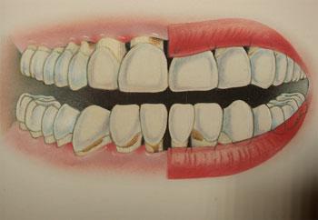 Diş Eti Çekilmesi Bitkisel Tedavi Öneriler burada!
