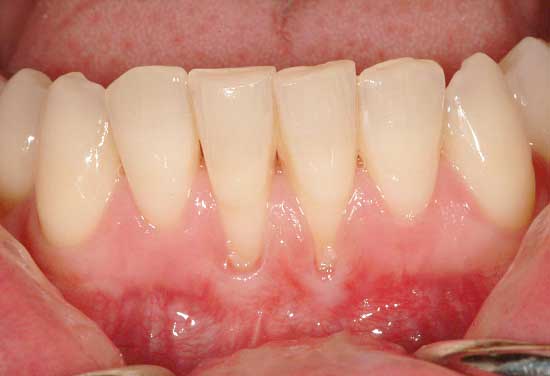 Diş eti hastalığı Diş eti çekilmesi ve nedenleri