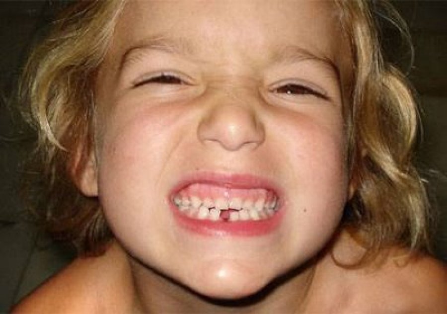 Diş gıcırdatması ( bruksizm ) nedenleri ve tedavisi