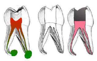 Diş kanal tedavisi kaç gün sürer?