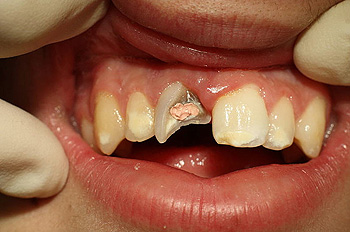 Diş kırılmasının tedavisi