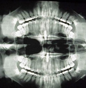 Diş röntgeni nasıl çekilir?