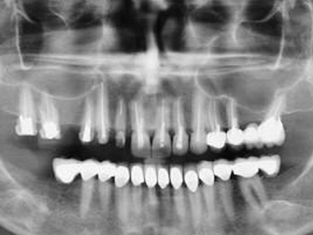 Diş Röntgenleri