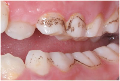 Dişlerdeki siyah lekeler neden oluşur?