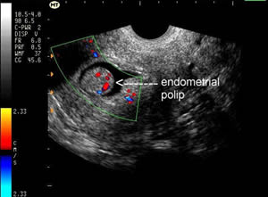 Endometrial Polipler