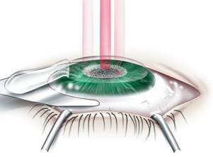 Excimer laser ile kornea refraksiyon cerrahisi
