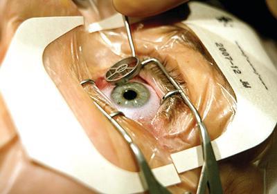 Göz çizdirme ameliyatı ne kadar?