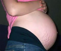 Hamilelikte karın çatlakları ve tedavi yolları