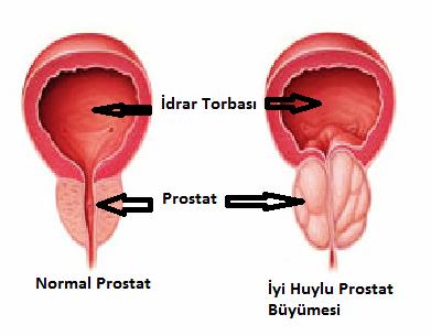 İyi huylu prostat büyümesi belirtileri