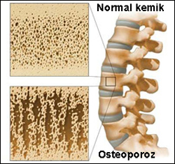 Kemik erimesi ( osteoporoz ) hastalığı nedir?