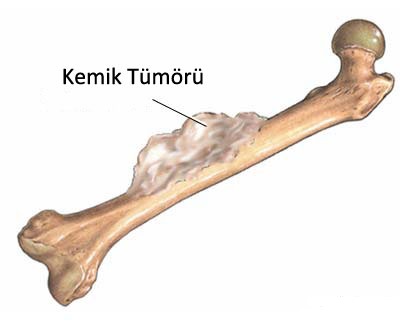 Kemik Tümörleri Faydaları