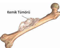 Kemik tümörü nasıl tedavi edilir?
