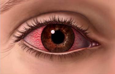 Kırmızı göz hastalığı belirtileri