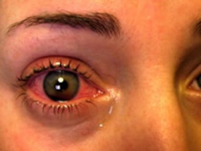 Kırmızı göz hastalığı nasıl tedavi edilir?