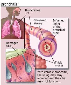 Kronik bronşit nedenleri