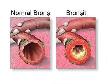 Kronik bronşit tedavisi