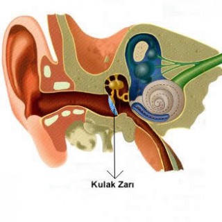Kulak zarı yırtılması belirtileri
